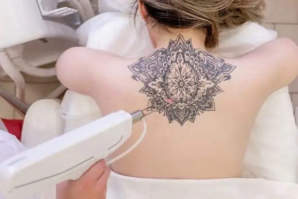 A white woman getting her tattoo removed through laser
