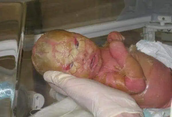 India's First Harlequin Baby 8