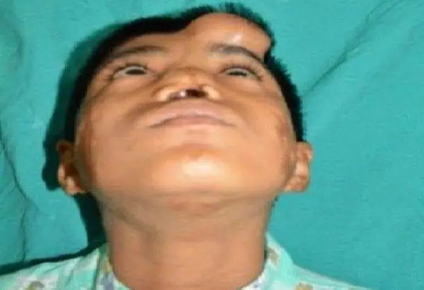 Indian Doctors Grow New Nose on Boy's Forehead 4