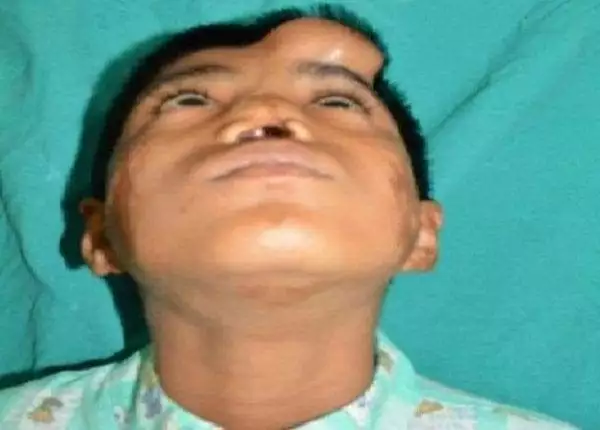 Indian Doctors Grow New Nose on Boy's Forehead 1