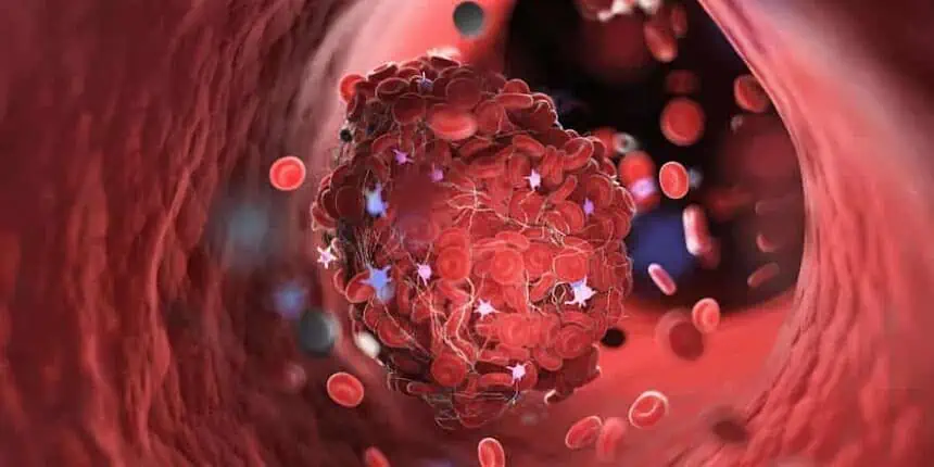 Promising Blood Clot Busting Treatment: Revealed 1 Blood clotting
