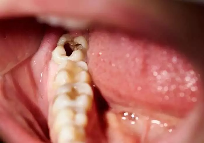 What Does a Cavity Look Like? 5 Best Treatment Options 4 What Does a Cavity Look Like? 5 Best Treatment Options 3