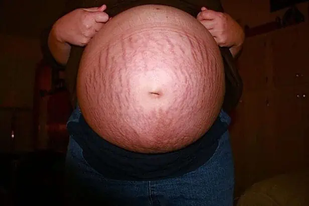 Pregnancy Stretch marks
