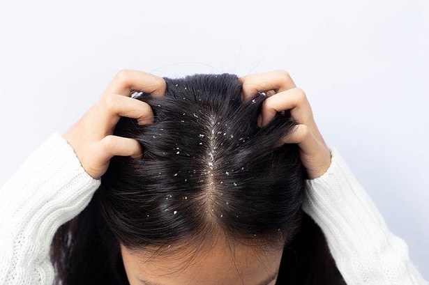 How to Get Rid of Dandruff: 10+ Best Natural Remedies 4