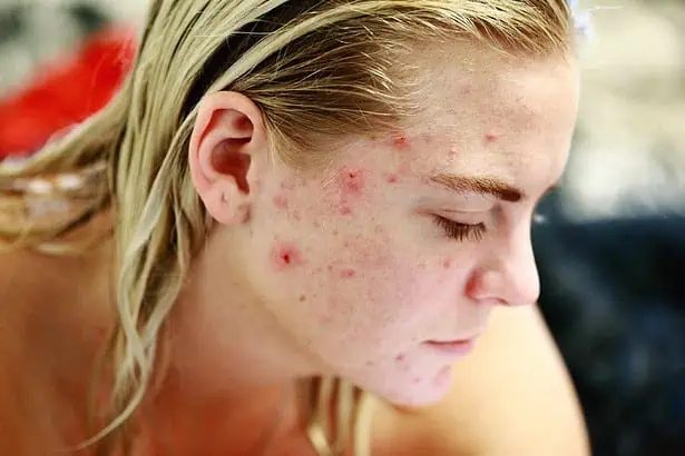 how to get rid of red spots on face