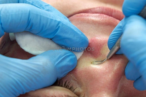 How to get rid of whiteheads