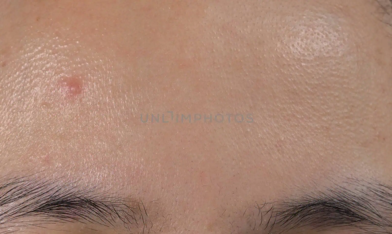 How to get rid of whiteheads 