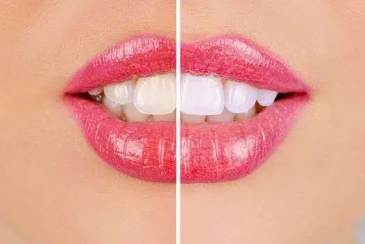 How to Get Whiter Teeth: 2 Best Options to Try 2 How to Get Whiter Teeth: 2 Best Options to Try 1