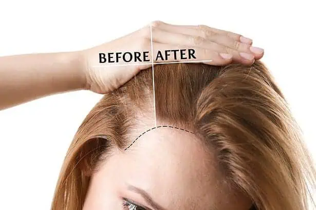 Hair transplant.