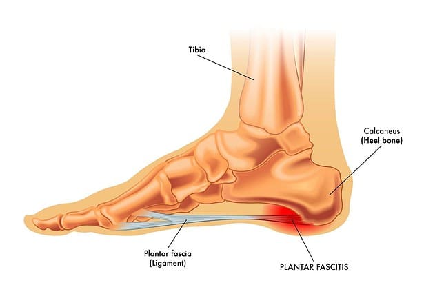 Plantar Fascitis analysis.