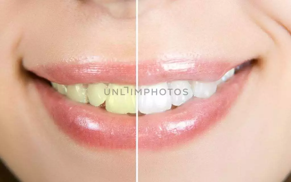 Baking Soda Teeth Whitening Hack | Excellent Facts About It ! 2 Baking Soda Teeth Whitening Hack | Excellent Facts About It !