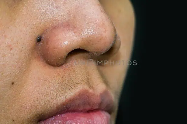 Home Remedies to Stop Facial Hair Growth in Females - 12 Best Remedies For You