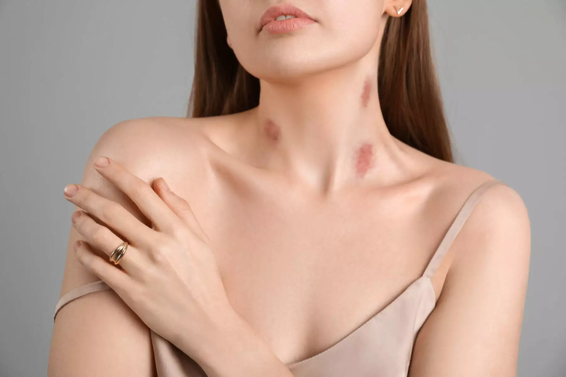 How to Get Rid of Hickeys: 11 Simple Solutions 2 How to Get Rid of Hickeys