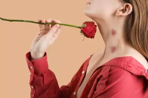 How to get rid of hickeys