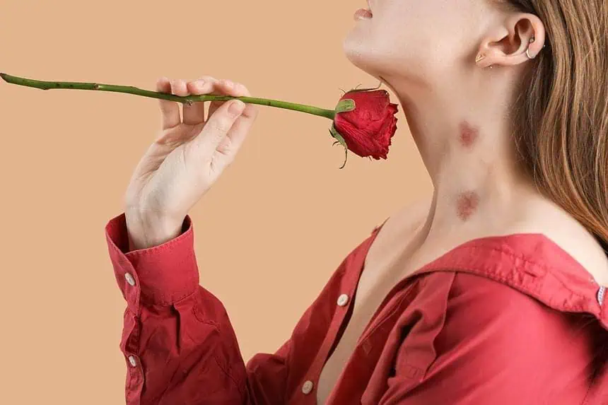 How to Get Rid of Hickeys: 11 Simple Solutions 1 How to get rid of hickeys
