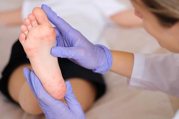 Doctor examining foot of child with red itchy rashes in clinic closeup.