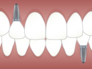 Is It Cheaper to Pull a Tooth or Root Canal?