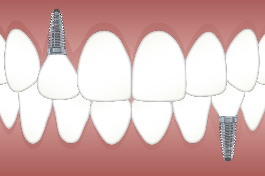 Is It Cheaper to Pull a Tooth or Root Canal?